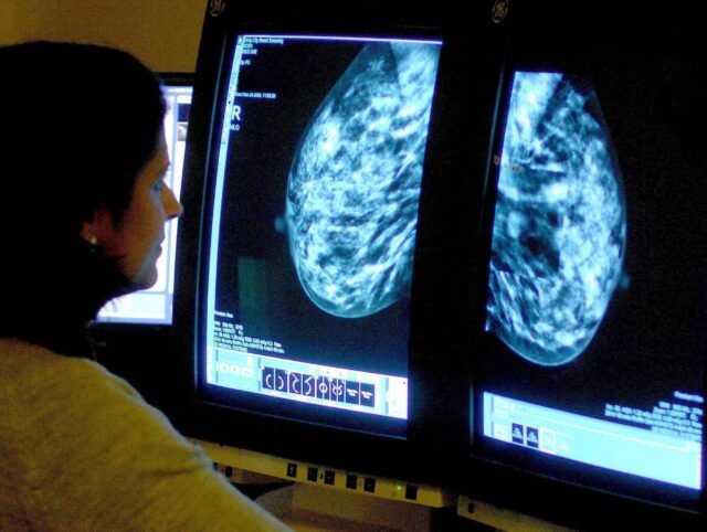 Indignación en las islas Baleares de España después de que las autoridades de salud "se olviden" de inscribir a 4,000 mujeres para el examen de cáncer de mama
