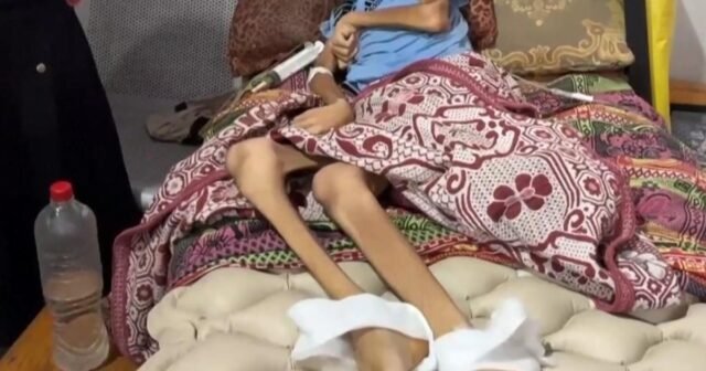 Imágenes perturbadoras de hambre en Gaza
